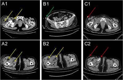 Case Report: Management of Multiple Deep-Tissue Cellulitis Without Sling Removal After an Anti-incontinence Procedure in a Female With Diabetes Mellitus